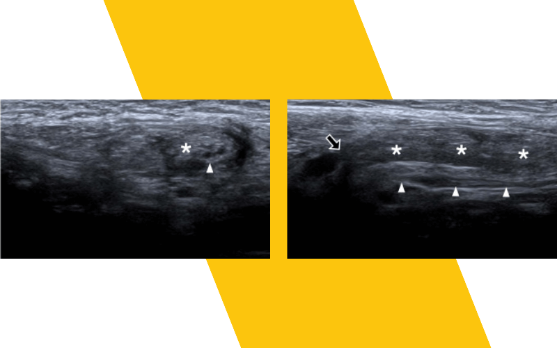 5. Hernia inguinal indirecta ecografia tempo formacion.png